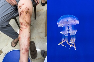 Da loang lổ tổn thương vì bị sứa chích khi tắm biển