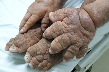 Người đàn ông mắc chứng da “vỏ cam”