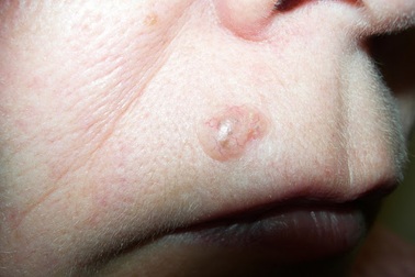 Nhận biết ung thư tuyến mồ hôi