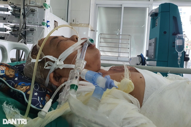 Vợ ngã vào chảo dầu sôi khi rán bánh, chồng hận mình sức yếu