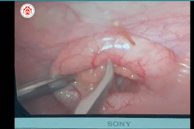 Hãi hùng hình ảnh tăm đâm thủng ruột bệnh nhân, gây viêm ruột thừa