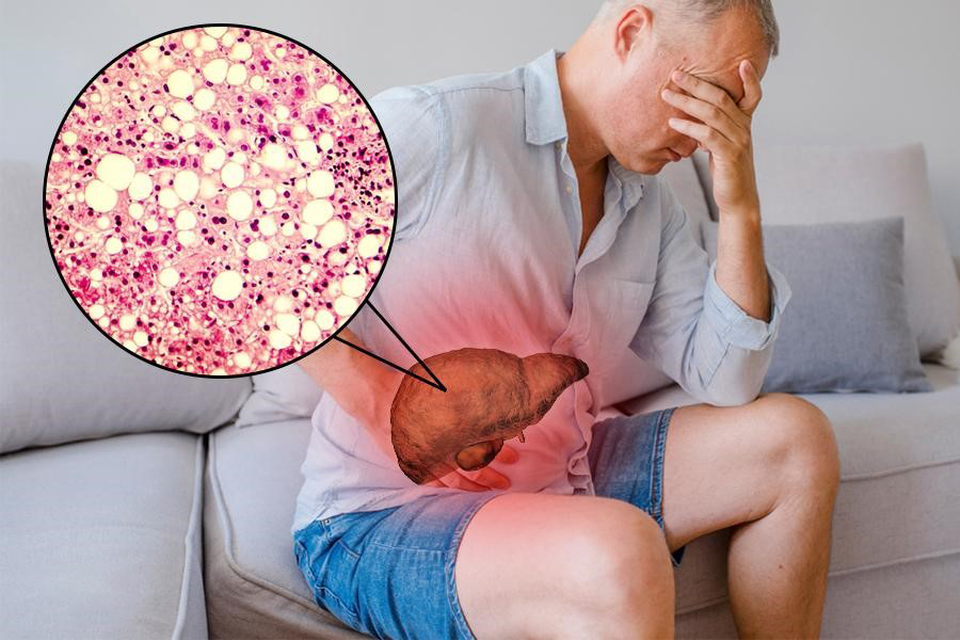 Bệnh gan gần 30 triệu người Việt mắc phải: Nguyên nhân chính từ lối sống - 1 Bệnh gan gần 30 triệu người Việt mắc phải: Nguyên nhân chính từ lối sống - 1