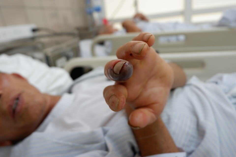 Người đàn ông sưng phù tay, hoại tử sau khi bị con rắn “tưởng đã chết” cắn - 3 Người đàn ông sưng phù tay, hoại tử sau khi bị con rắn “tưởng đã chết” cắn - 3