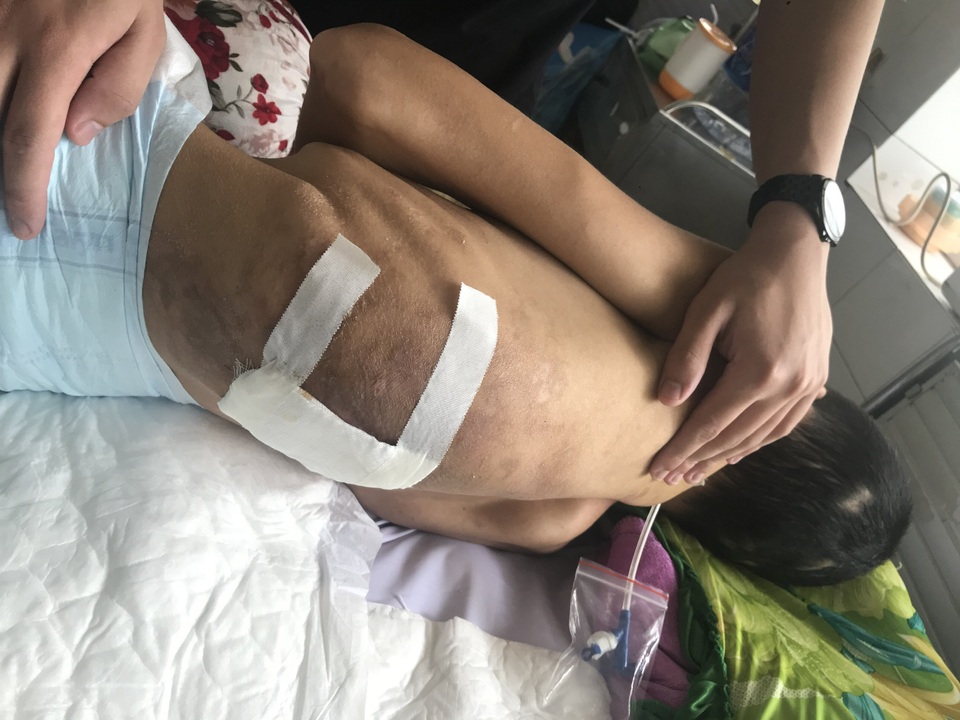 Thương người mẹ nghèo bệnh tật lận đận rời quê vào chăm con sau vụ tai nạn - 3 Thương người mẹ nghèo bệnh tật lận đận rời quê vào chăm con sau vụ tai nạn - 3