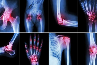 Điều trị đau khớp bằng phương pháp thông thường có thể có hại hơn chúng ta nghĩ