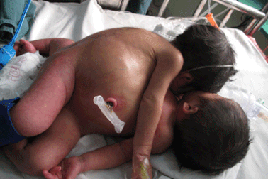 Mới chỉ tạo hậu môn cho cặp song sinh dính liền