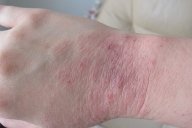 Những đồn đoán và hiểu biết sai về bệnh vảy nến