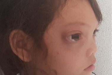 Em học trò nghèo bị khối u khổng lồ đẩy lồi mắt