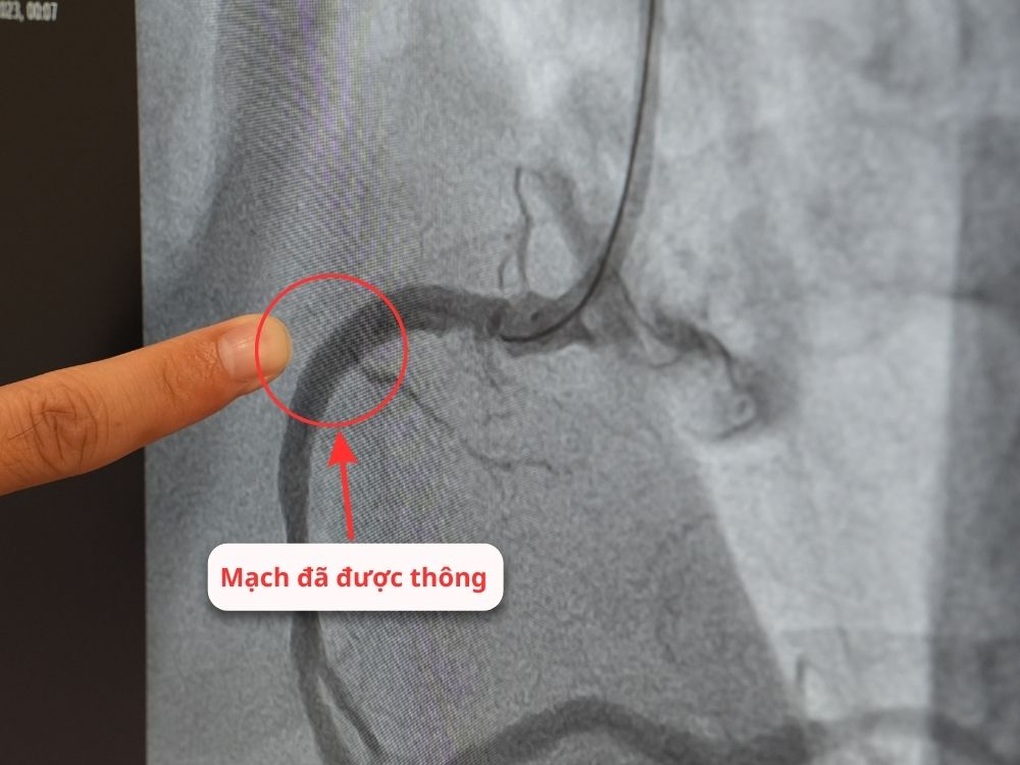 Vượt 100km tới Bệnh viện Hồng Ngọc vì muốn bác sĩ Nguyễn Văn Hải đặt stent - 2 Vượt 100km tới Bệnh viện Hồng Ngọc vì muốn bác sĩ Nguyễn Văn Hải đặt stent - 2