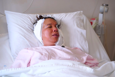 Bỏng lò than, người phụ nữ không thể mở miệng ăn, uống suốt 23 năm
