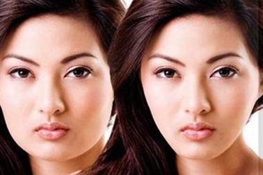 Phẫu thuật biến khuôn mặt chữ U thành V