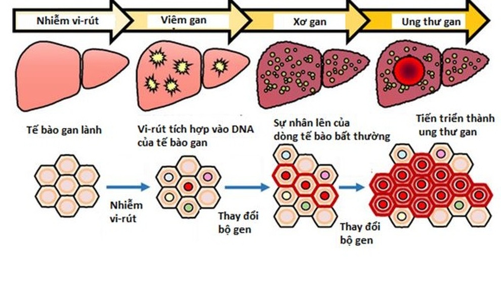 Mối liên hệ giữa viêm gan B và ung thư gan - 2 Mối liên hệ giữa viêm gan B và ung thư gan - 2