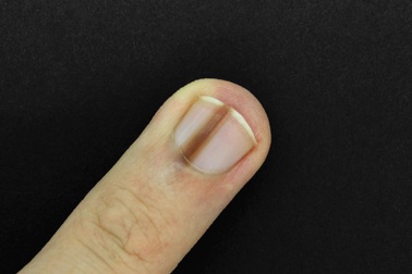 7 triệu chứng ở móng tay không nên bỏ qua