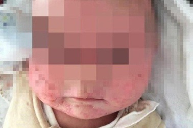 Câu chuyện đau lòng cảnh báo về "nụ hôn của mẹ" khi chăm sóc trẻ