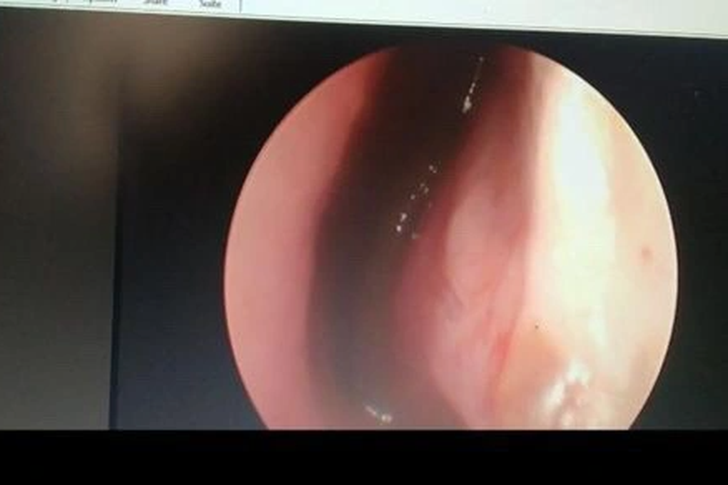 Đi tắm suối, cháu bé 10 tuổi bị đỉa chui vào mũi, ký sinh suốt nhiều ngày - 1 Đi tắm suối, cháu bé 10 tuổi bị đỉa chui vào mũi, ký sinh suốt nhiều ngày - 1