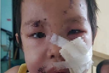 Hai chị em bị thương nặng do chó nhà hàng xóm tấn công