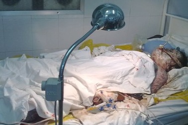 Thắp nến gây cháy nệm, một cháu bé nguy kịch