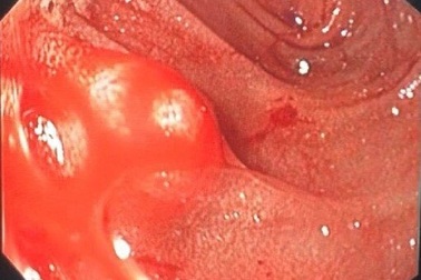 Nam bệnh nhân suýt “khô máu” vì nguyên nhân hiếm gặp