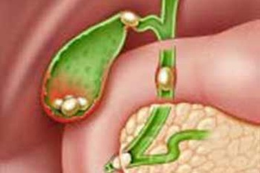 Dự phòng tái phát sỏi mật 