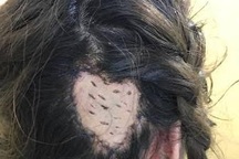 Mất vành tai, lóc da đầu vì... uốn hấp tóc