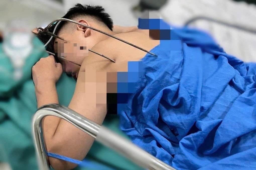 Dị vật 3 càng đâm thấu tim nam thanh niên 17 tuổi ở Hà Nội - 1 Dị vật 3 càng đâm thấu tim nam thanh niên 17 tuổi ở Hà Nội - 1