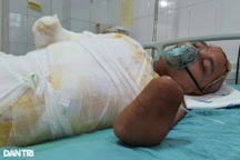 Cú phóng điện cao thế khiến người đàn ông mất đôi tay, nguy kịch tính mạng