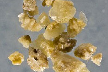 Vì sao sỏi thận thường bùng nổ vào mùa xuân?