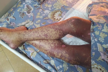 Người đàn ông suýt chết vì tự uống thuốc khi có triệu chứng phổ biến này