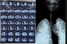 Cứu người đàn ông bị khối u hiếm gặp chặn đường thở nguy kịch