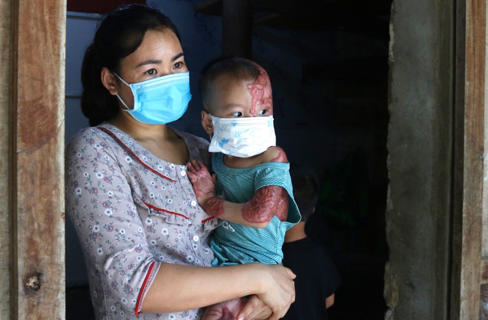 Cháu bé 2 tuổi bị bỏng xăng nặng được bạn đọc giúp đỡ gần 500 triệu đồng - 2 Cháu bé 2 tuổi bị bỏng xăng nặng được bạn đọc giúp đỡ gần 500 triệu đồng - 2