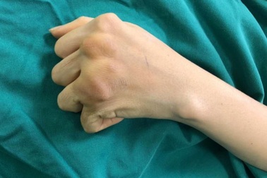 Người phụ nữ 38 tuổi bất lực 10 năm không thể tự chải tóc vì khớp xương biến dạng