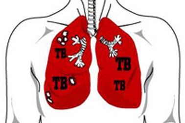Điều trị lao sẽ chỉ mất 2 tuần?