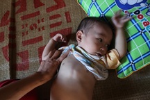 Nhói lòng đứa trẻ 15 tháng tuổi tím ngắt vì bệnh tim phức tạp