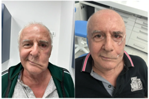 Phẫu thuật khôi phục nét mặt cho bệnh nhân bị liệt dây thần kinh số 7