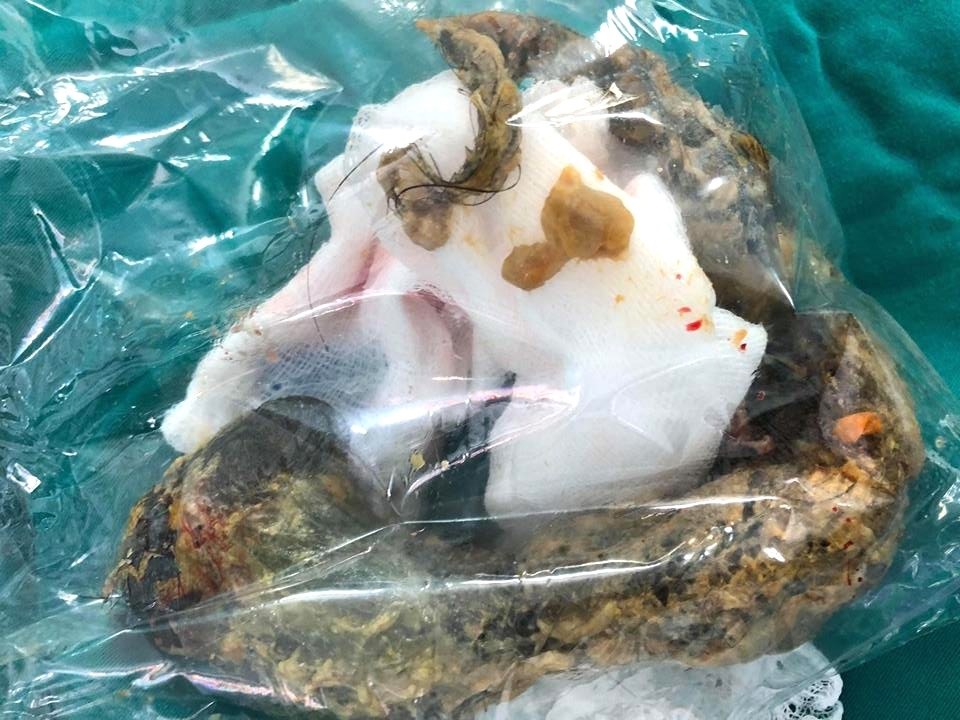 Bé gái 8 tuổi bị tắc ruột vì mắc hội chứng công chúa tóc mây - 2 Bé gái 8 tuổi bị tắc ruột vì mắc hội chứng công chúa tóc mây - 2