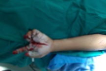 Bé trai 11 tuổi chi chít vết thương do tai nạn pháo nổ