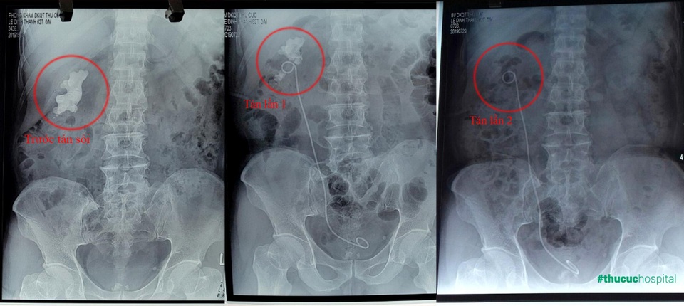 Thoát mổ rạch lấy sỏi thận 7cm nhờ “đường hầm” siêu nhỏ - 3 Thoát mổ rạch lấy sỏi thận 7cm nhờ “đường hầm” siêu nhỏ - 3