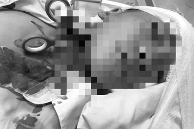 Bé trai 7 tuổi nhập viện với chiếc kéo đâm xuyên vào cổ