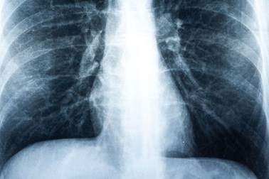 Bệnh nhân đầu tiên trên thế giới phải ghép phổi do hút vape