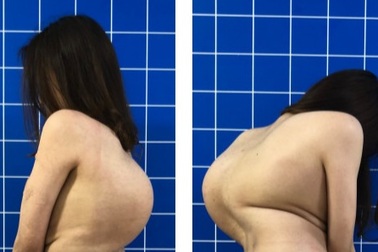 Giải cứu cô gái mang "mai rùa" trên lưng