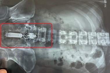 Sextoy kẹt trong trực tràng người đàn ông khi đang "tự sướng"