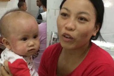 Nguy cơ nhiễm trùng máu vì viêm da, mụn nhọt ngày hè