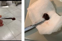 Gắp con vắt dài 6cm "ngo ngoe" trong mũi bệnh nhân