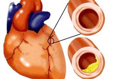 Cảnh giác với biến chứng tim mạch ở người bệnh tiểu đường