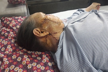 Quảng Bình: Phẫu thuật ghép da mặt thành công cho bệnh nhân ung thư da