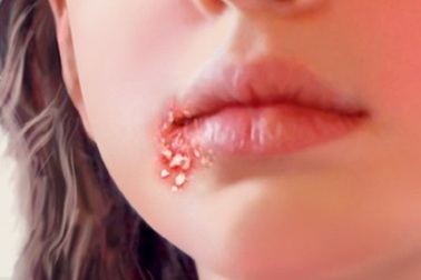 Bệnh zona ở mặt điều trị thế nào?