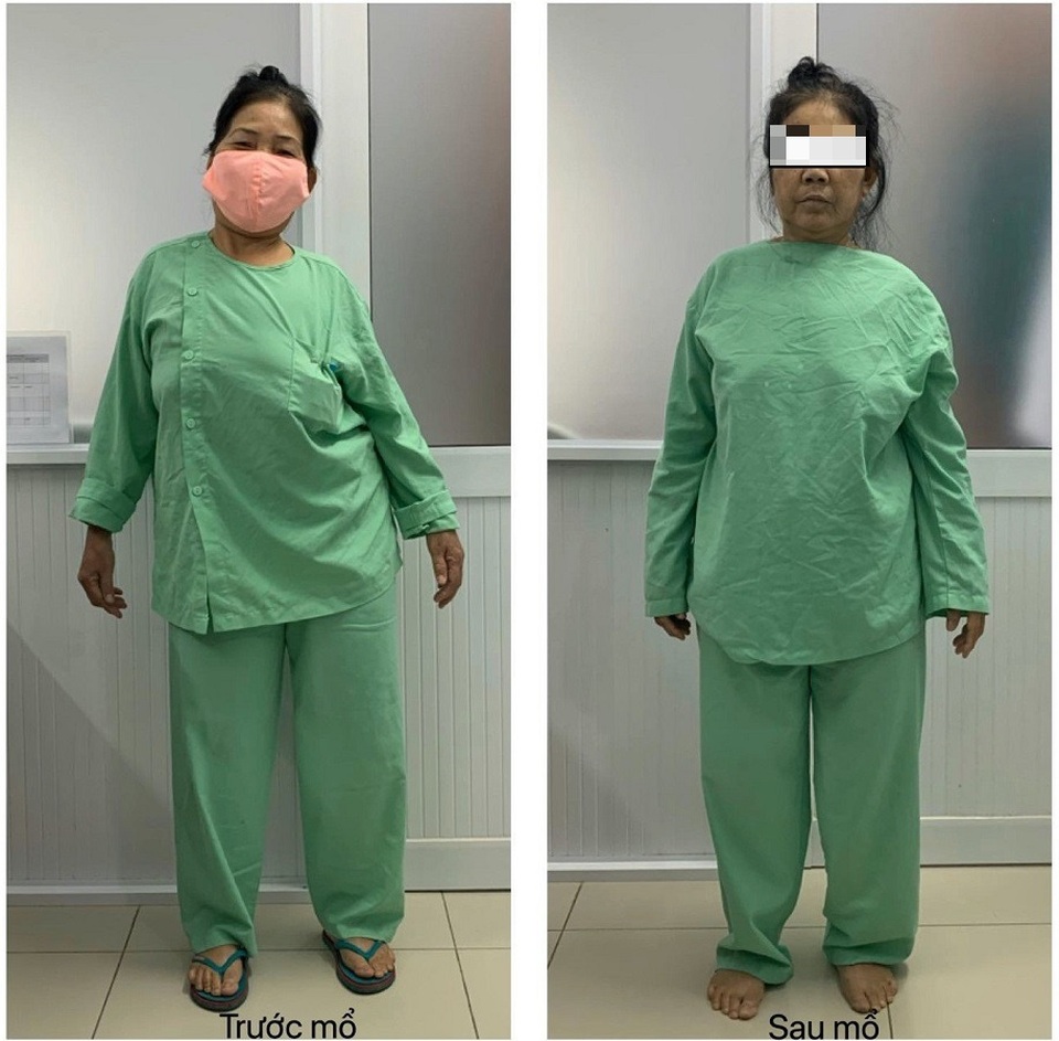 Đục xương sửa trục, cứu bệnh nhân biến dạng cột sống - 2 Đục xương sửa trục, cứu bệnh nhân biến dạng cột sống - 2