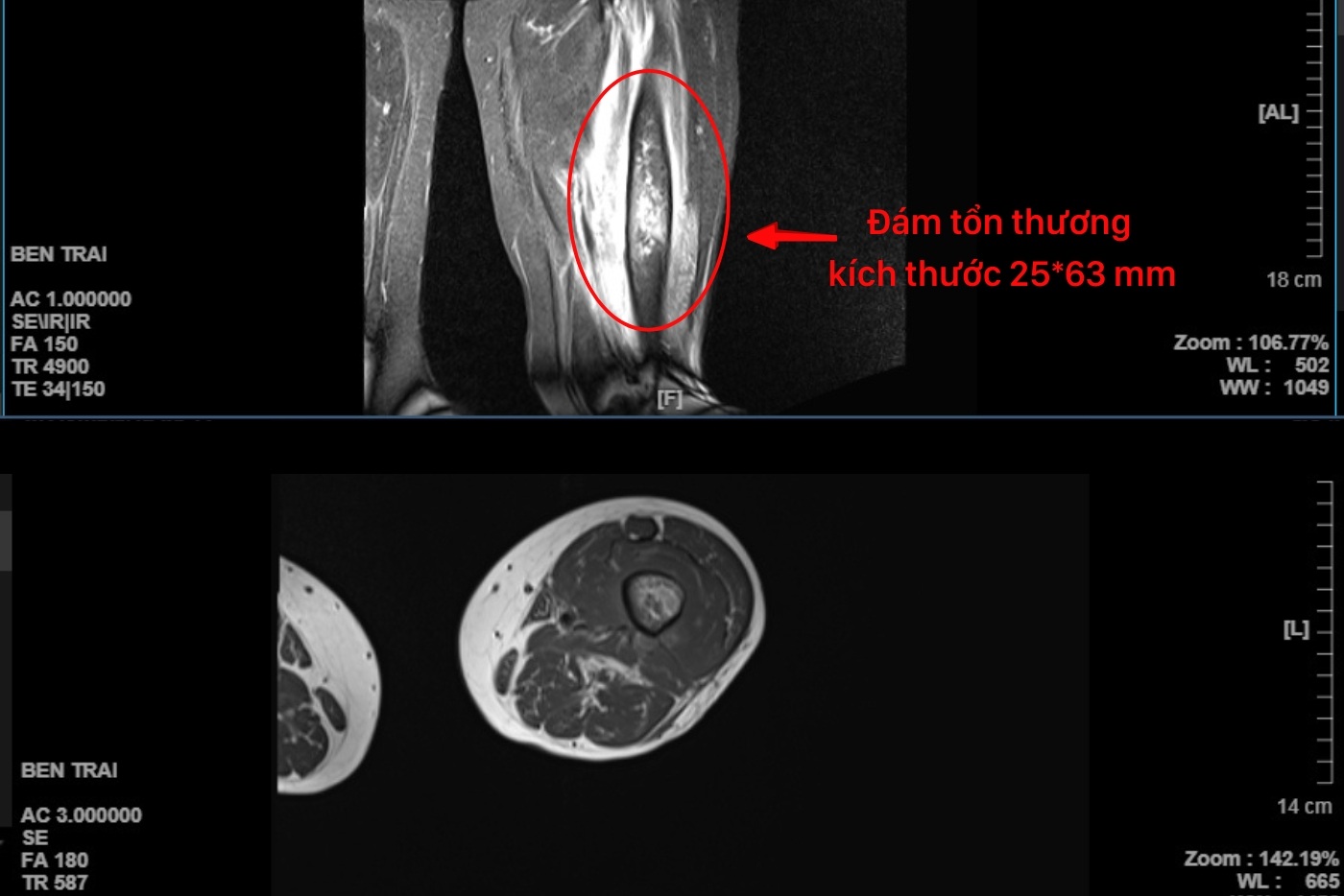 Tưởng đau thần kinh tọa, bệnh nhân nữ 64 tuổi suýt phải cắt bỏ chân - 2
