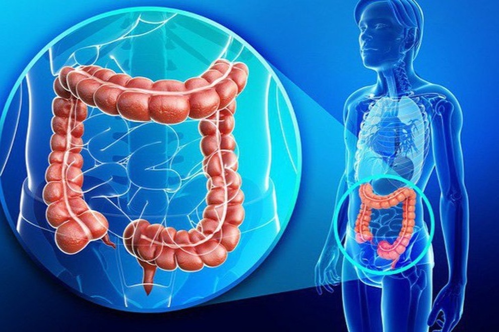 Ung thư đại trực tràng dễ ghé thăm người có những đặc điểm này - 1 Ung thư đại trực tràng dễ ghé thăm người có những đặc điểm này - 1