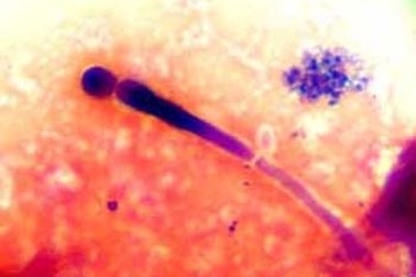 Cách phòng bệnh nấm sinh dục trong mùa nóng ẩm